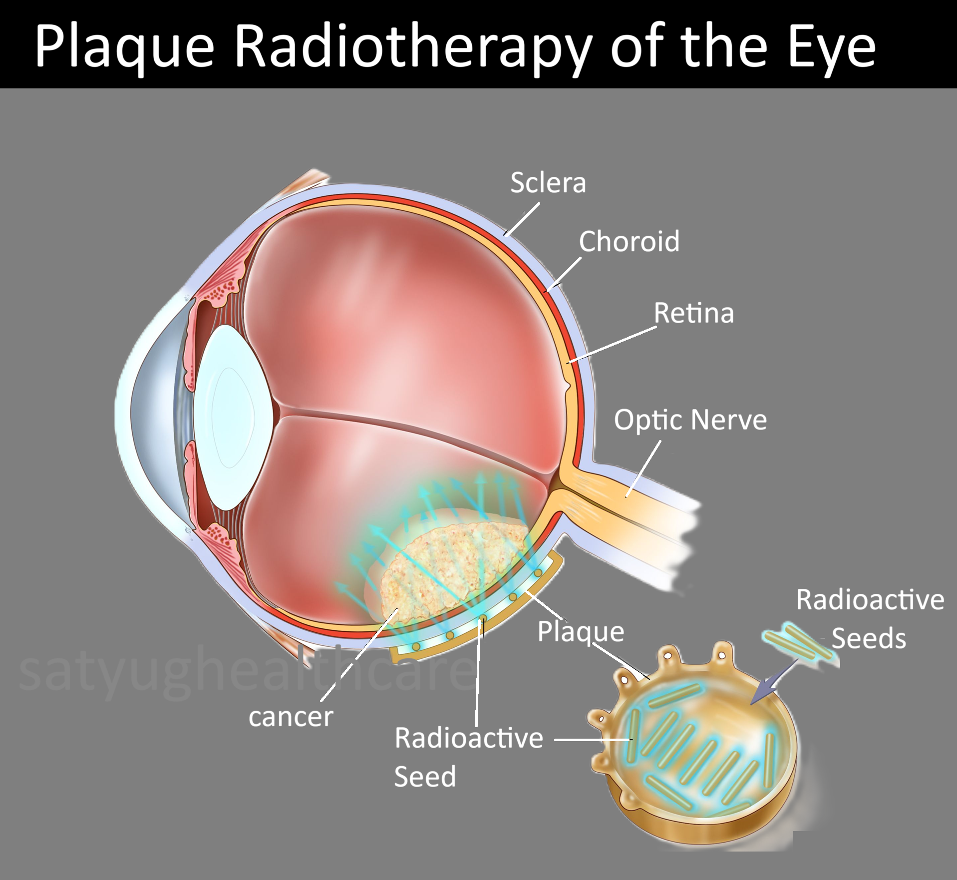 Plaque Radiotherapy of the Eye Treatment in India